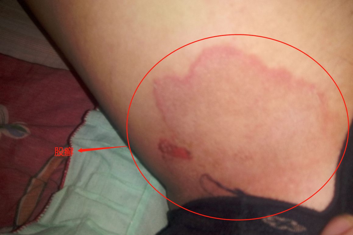 股癣