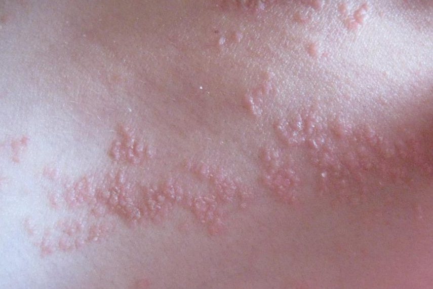 泛发型胎生疣状痣