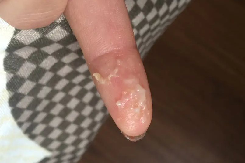 霉菌性阴道炎典型症状：豆腐渣样白带