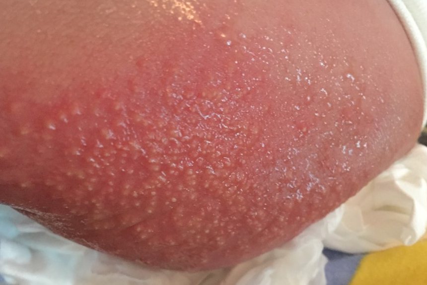 传染性湿疹样皮炎