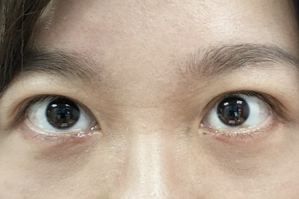 激光去眼袋恢复期