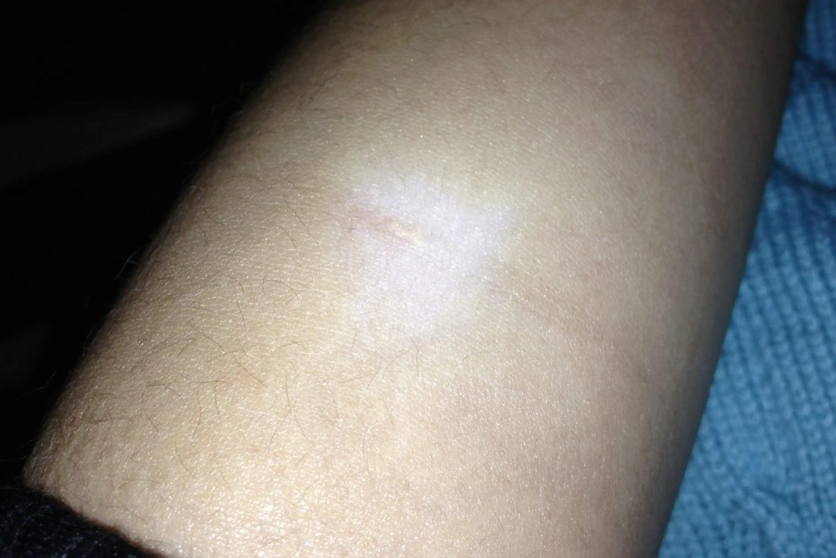 药物引起皮肤萎缩