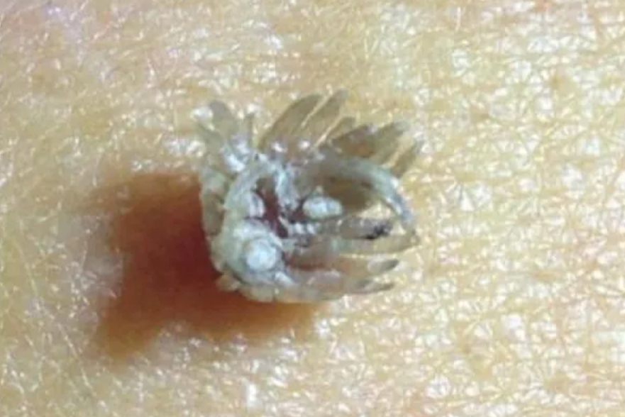 肚子上长丝状疣