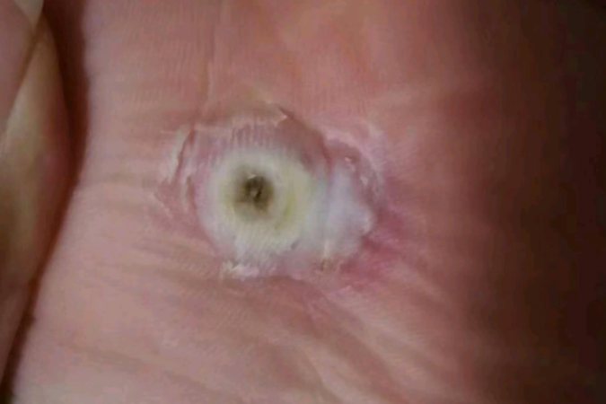 跖疣刚开始状态