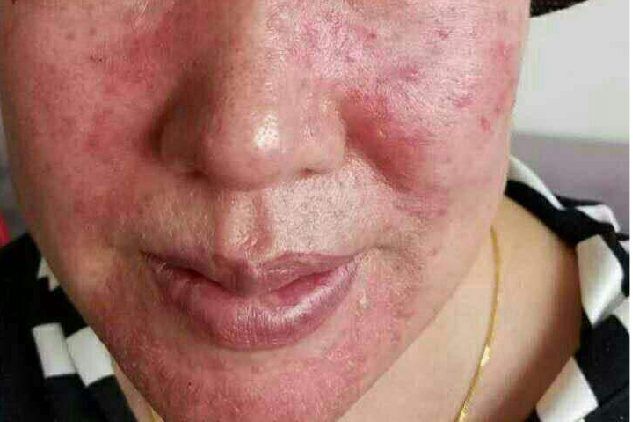 严重激素脸图片