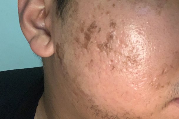 点阵激光去水痘坑效果图