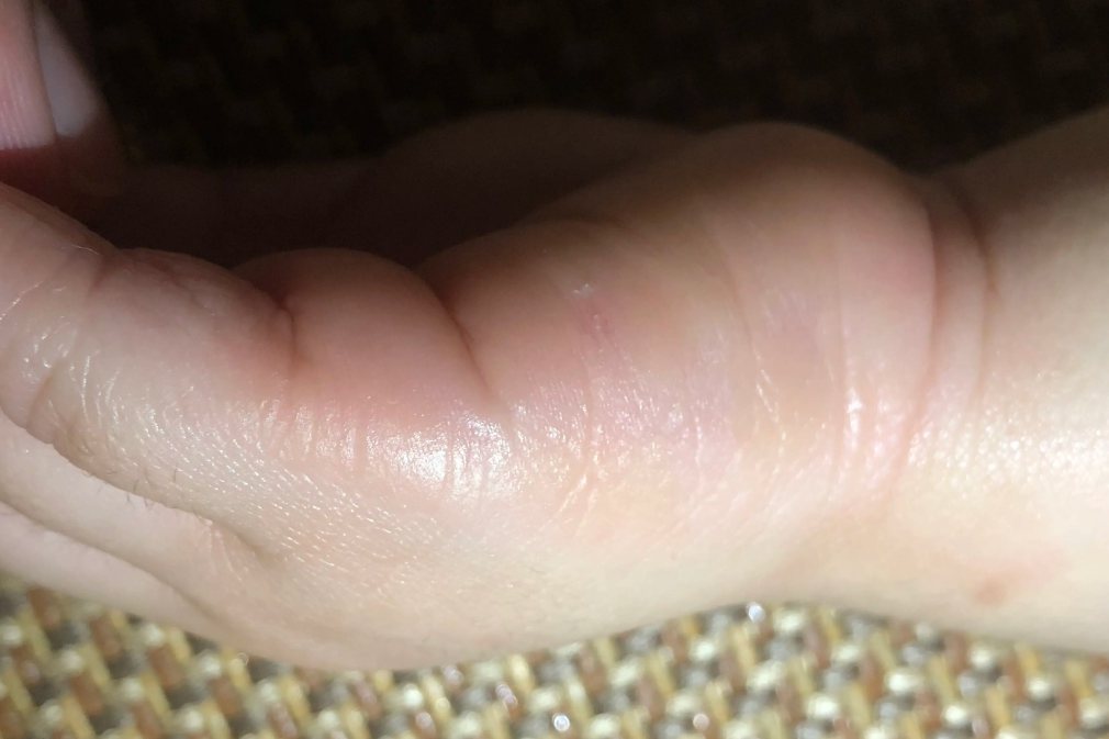 婴儿期变应性湿疹