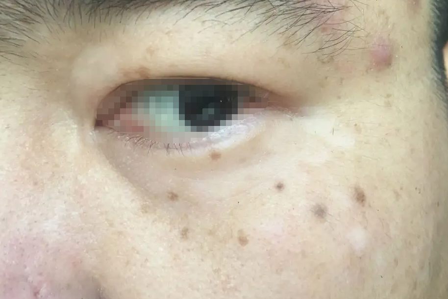 贫血痣