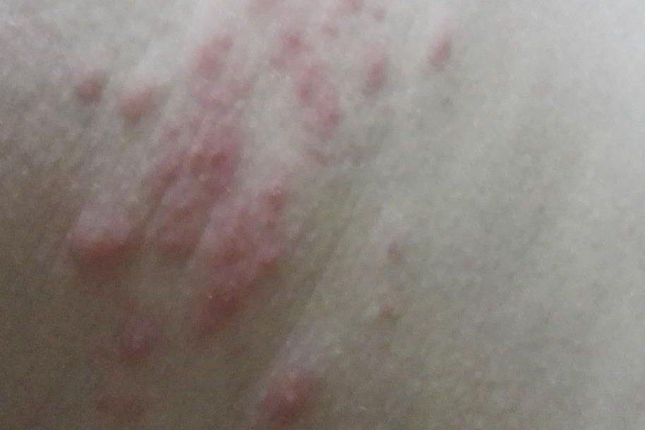 蚂蚁咬的包