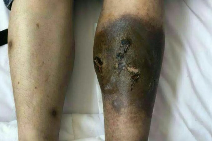 腿部深静脉血栓