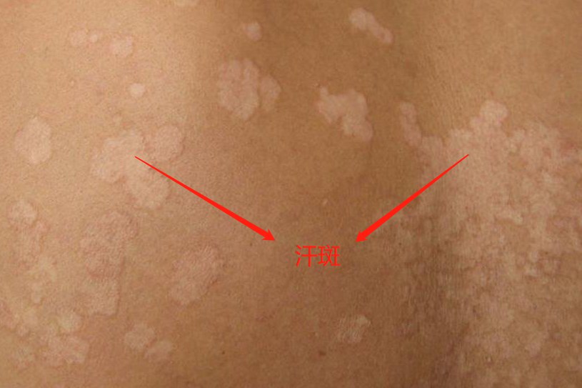 汗斑早期图片