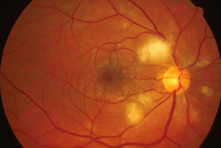 视网膜组织缺血