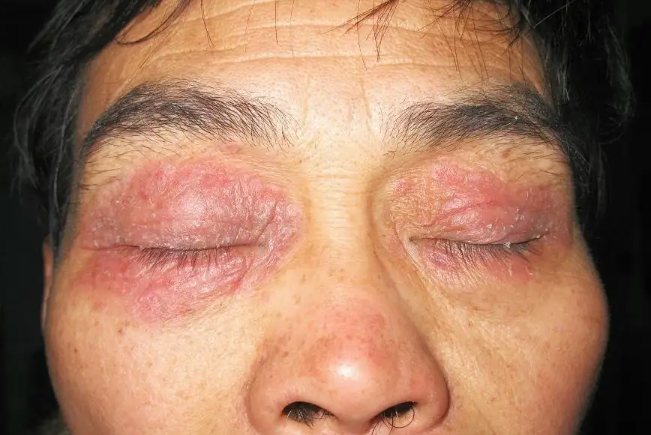 眼皮皮炎