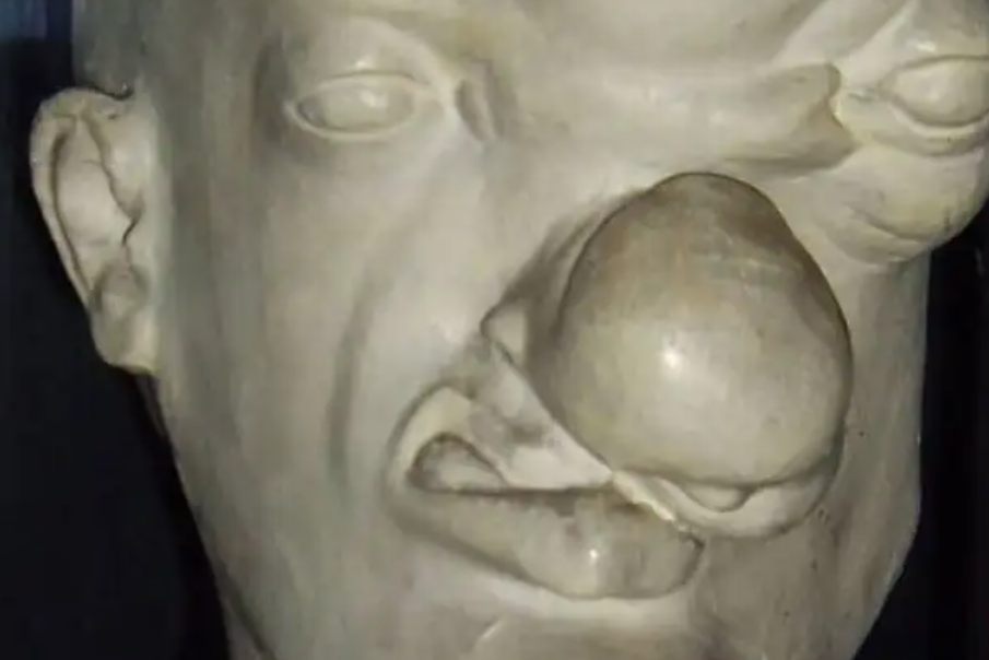 梅毒瘤外观模型