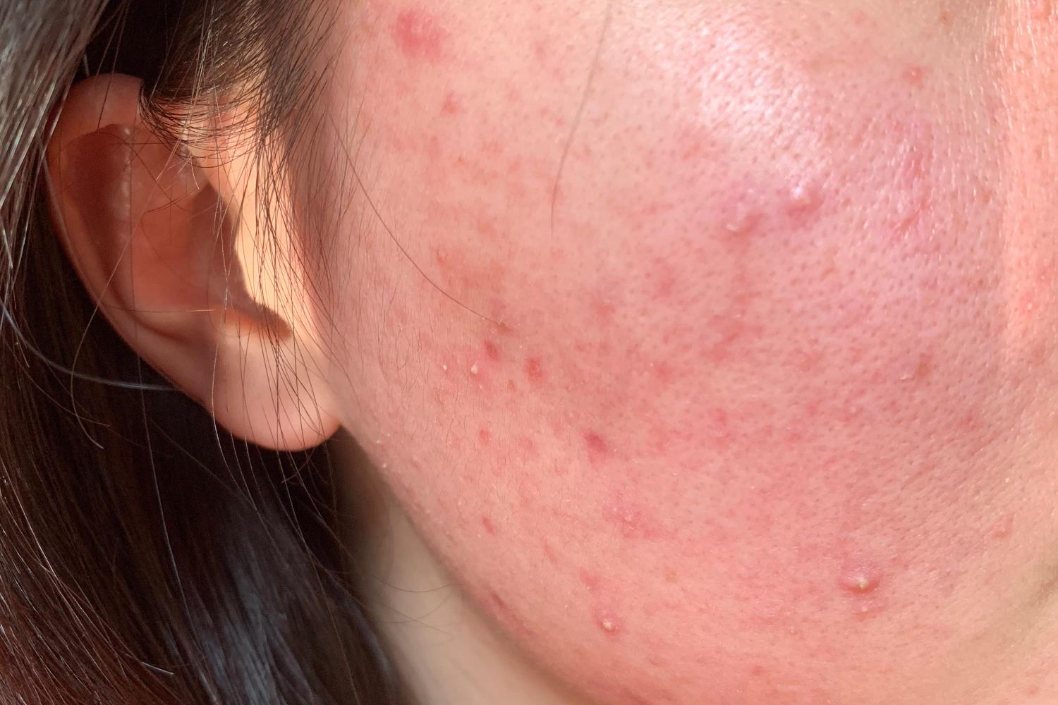 由螨虫引起的痘痘