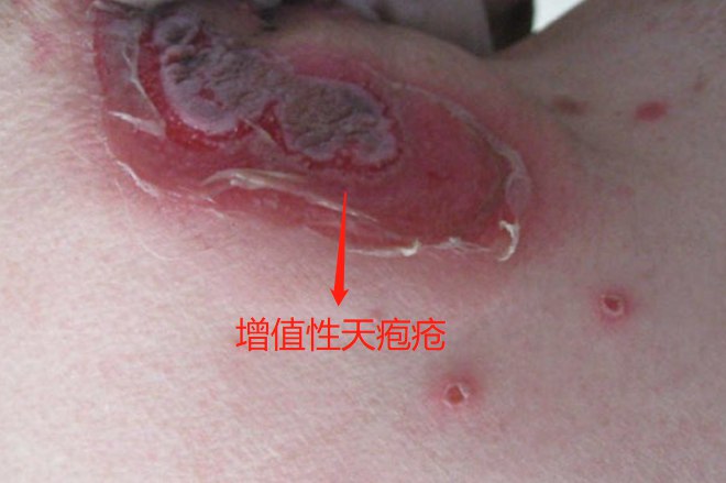 增值性天疱疮