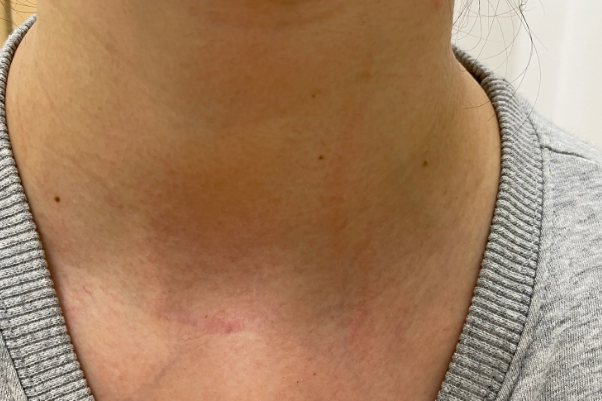 腔镜式手术伤口