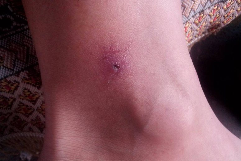 恙虫咬人后伤口