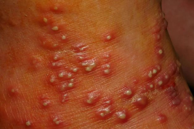 红火蚁咬伤图片