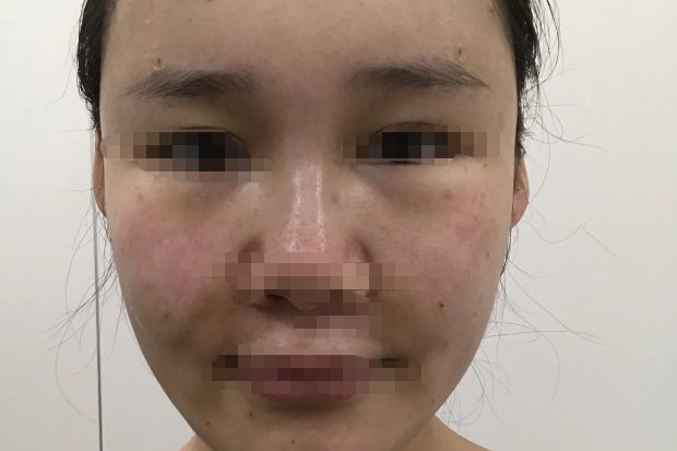 脂肪填充泪沟肿胀图片