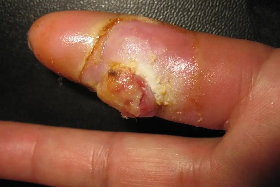 蛇头疮（指头炎）