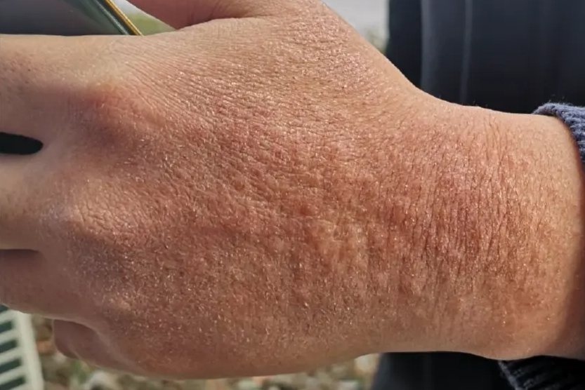 刺激性接触性皮炎