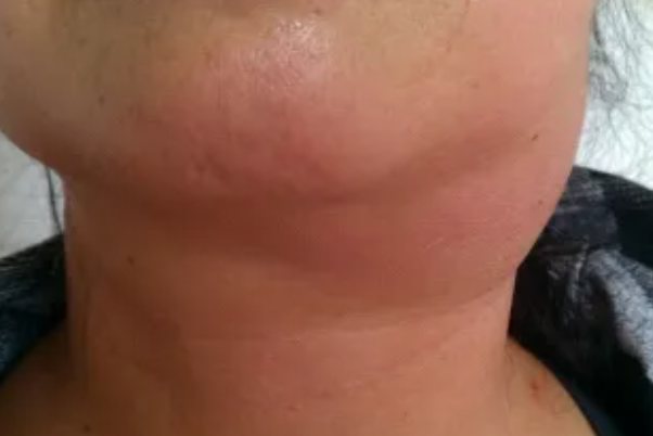 急性颌下淋巴结肿大