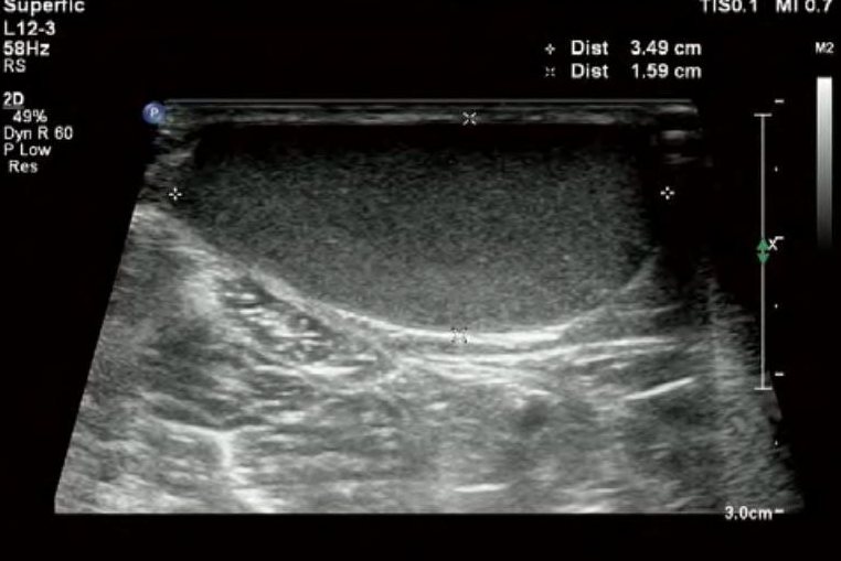 皮脂腺囊肿彩超