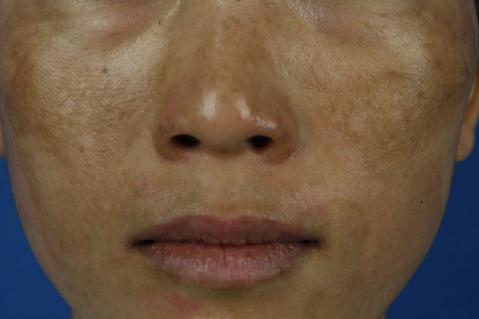 脸上色素沉着的图片