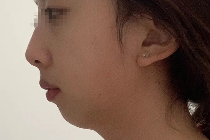 下巴后缩图片