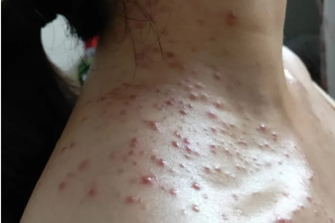 肩部马拉色菌毛囊炎