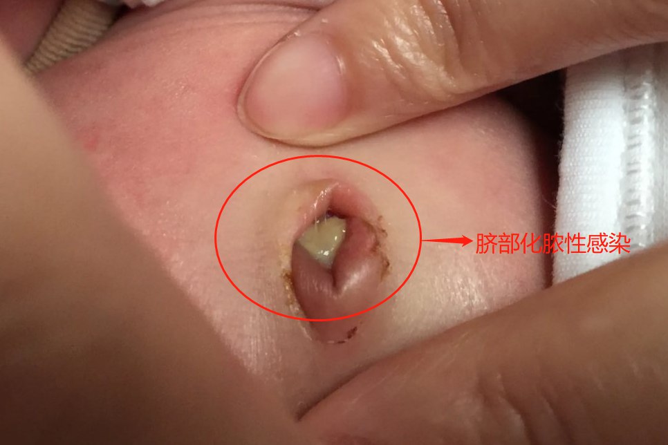 脐部化脓性感染图片
