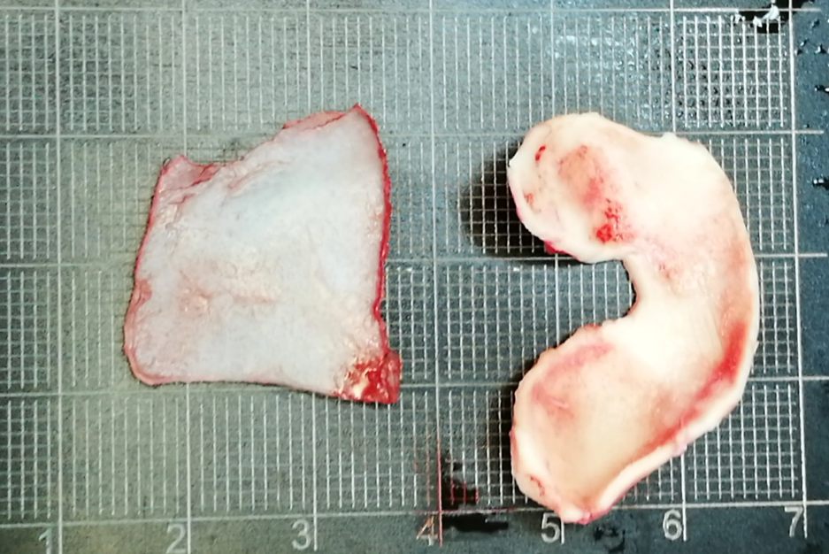 单侧耳软骨隆鼻