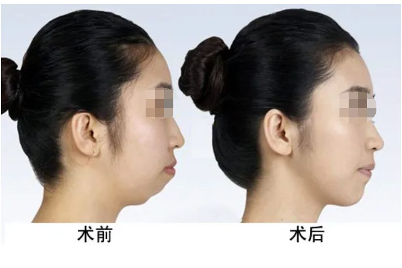 下巴填充前后对比