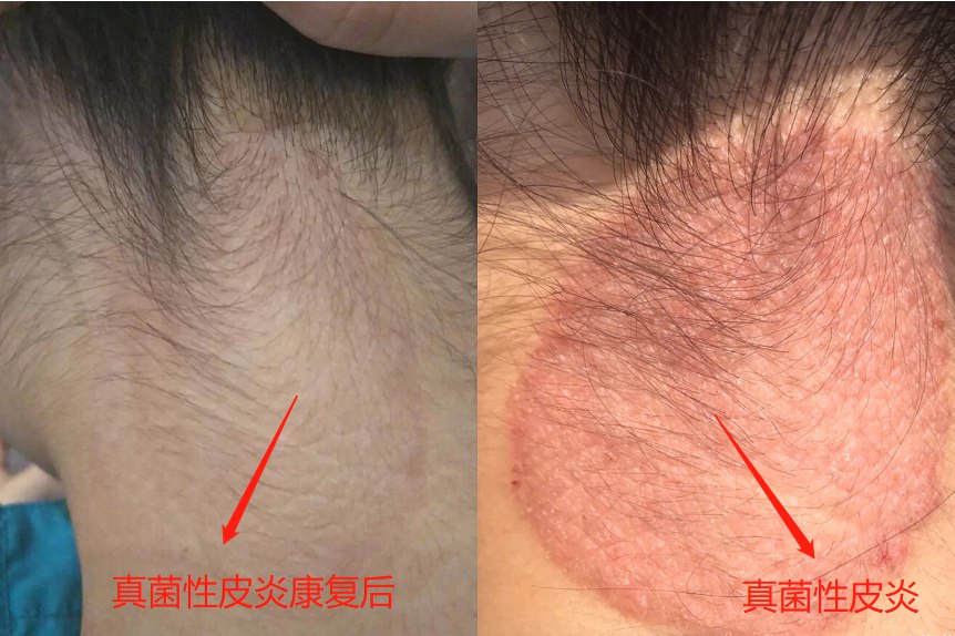 真菌性皮炎症状对照图片