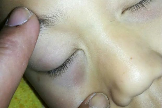 婴儿下眼袋发红