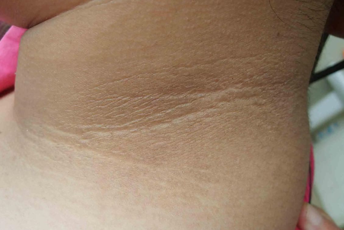 肥胖型黑棘皮症