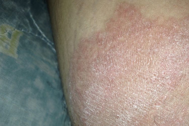 皮肤苔癣样变图