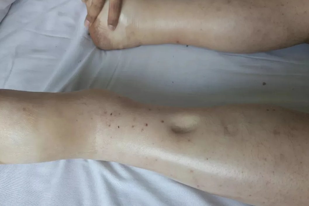 凹陷性水肿