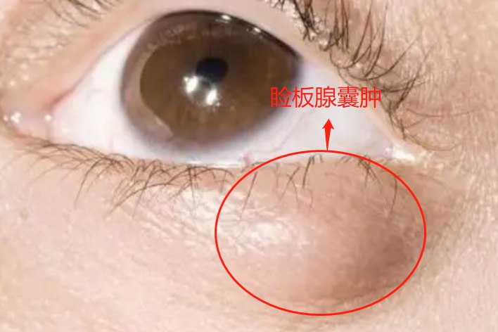 睑板腺囊肿