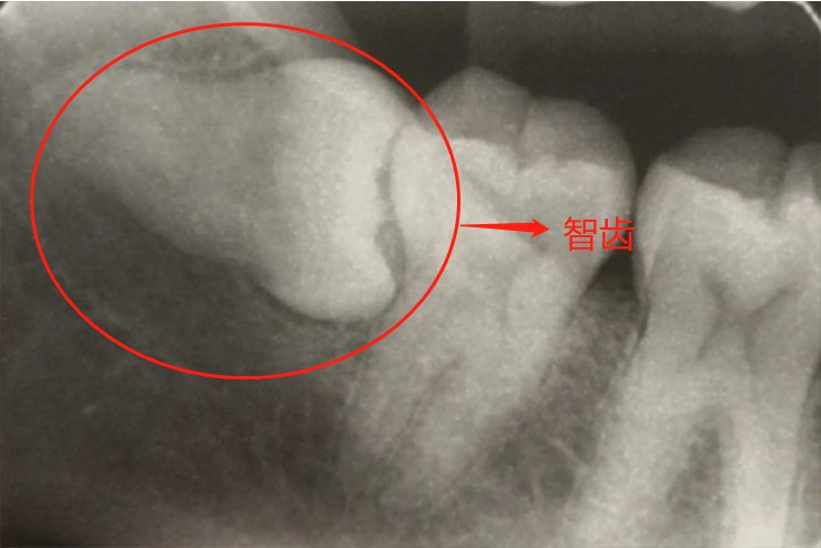 智齿