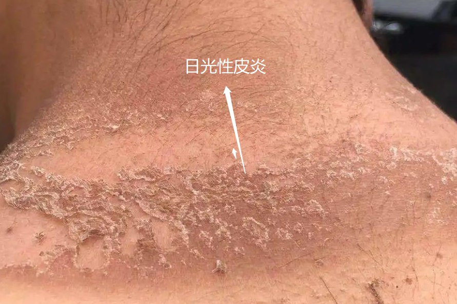 日光性皮炎图片