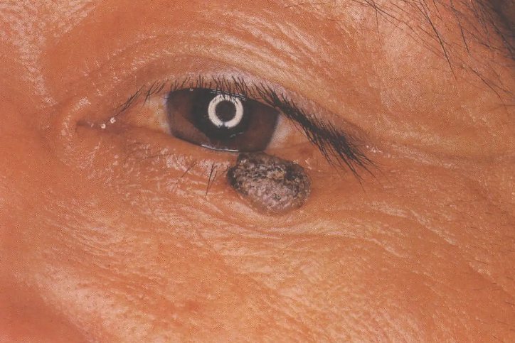 眼睑色素痣