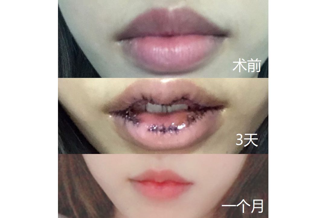 嘴唇改薄手术后一个月