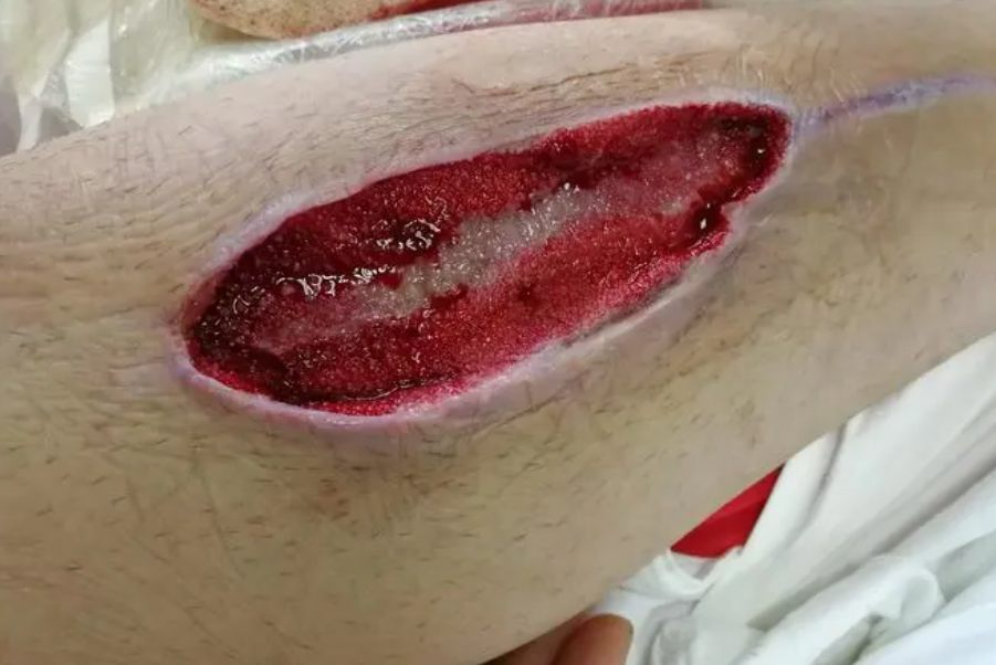 皮开肉绽的伤口