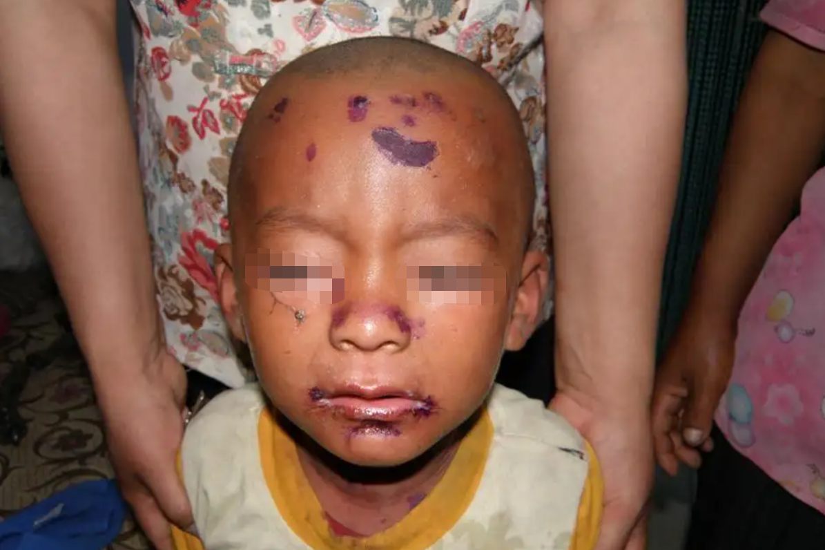 葡萄球菌皮肤烫伤样综合征