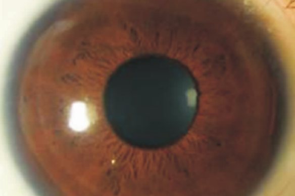 角膜接触镜造成的角膜浸润