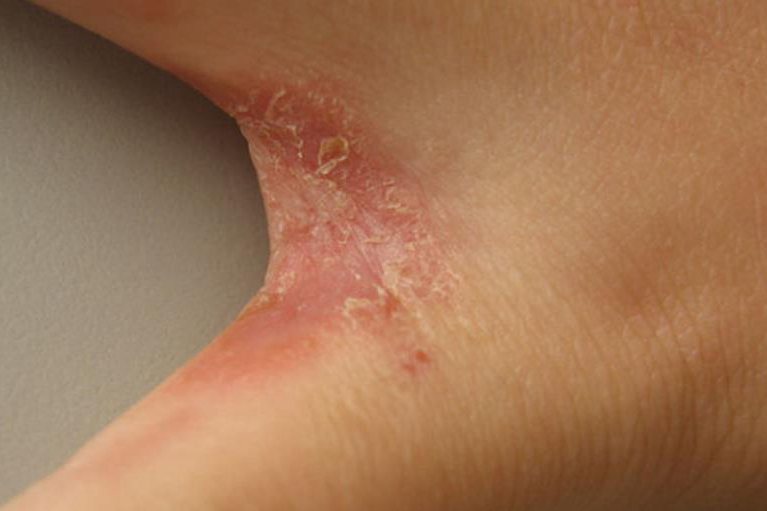 手上感染了真菌