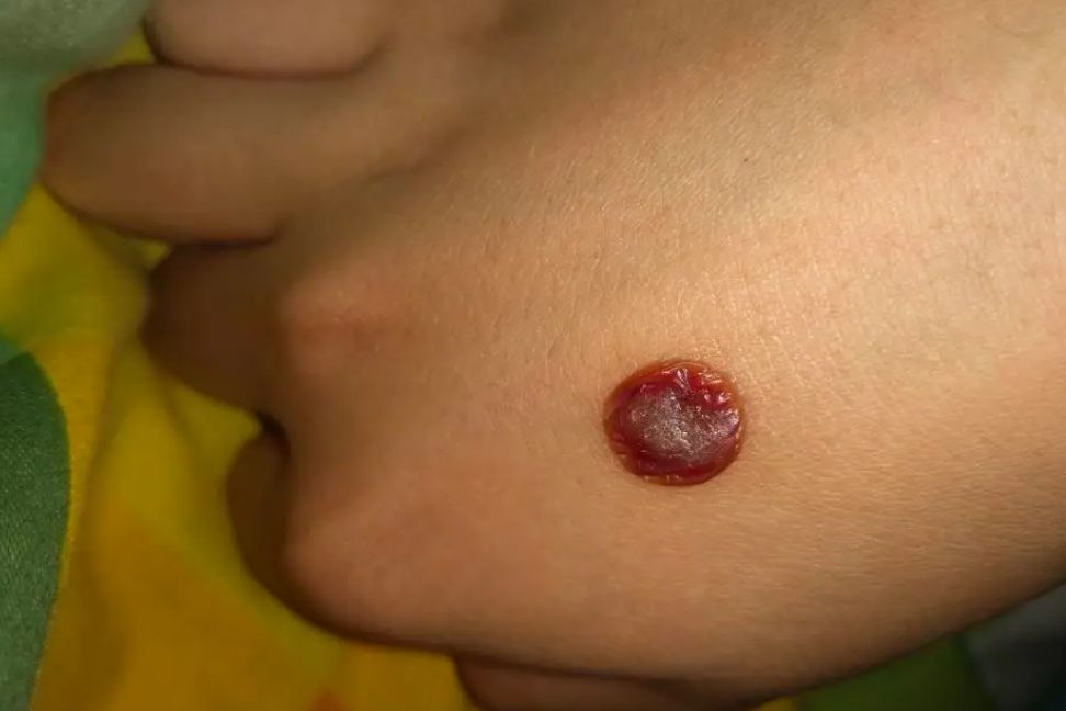 寻常疣冷冻治疗