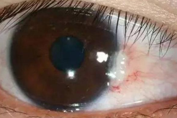 翼状胬肉白色结节凸起图